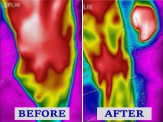 Before And After Theraphi